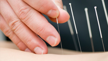 Acupuncture is part of Traditional Chinese Medicine, which originated in China over 5,000 years ago.