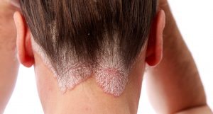 Biologic Therapy (Psoriasis and Eczema)