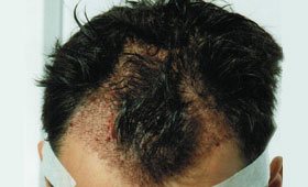 hair graft clinics in perth Martinick Hair Restoration