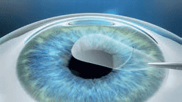 clinics myopia operation in perth WA Laser Eye Centre - Melville